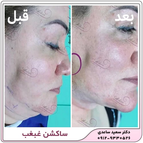 نمونه کار ساکشن غبغب
