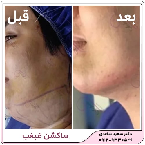 نمونه کار ساکشن غبغب