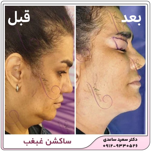 نمونه کار ساکشن غبغب