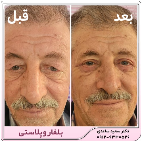 بلفاروپلاستی