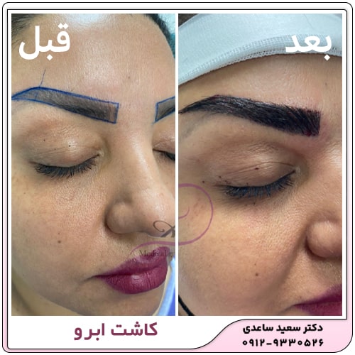 کاشت ابرو