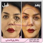 بلفاروپلاستی پلک