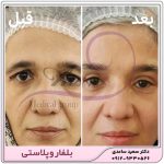 بلفاروپلاستی پلک