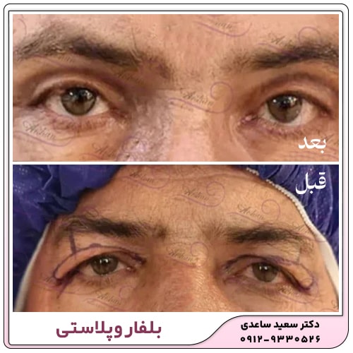 نمونه کار بلفاروپلاستی