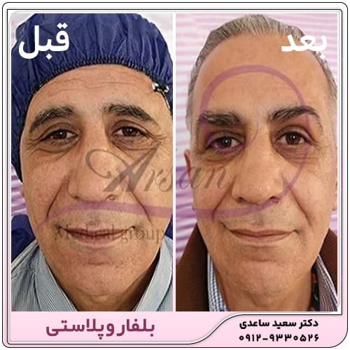 نمونه کار بلفاروپلاستی