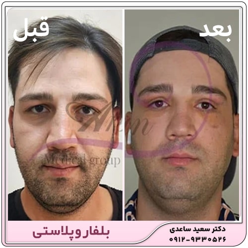 نمونه کار بلفاروپلاستی