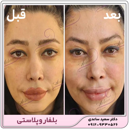 نمونه کار بلفاروپلاستی