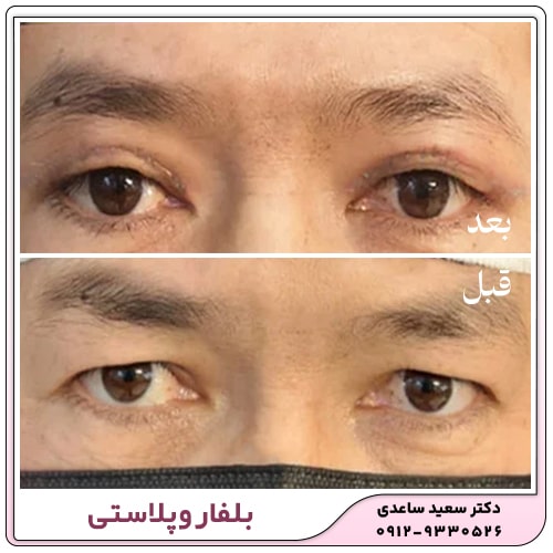 نمونه کار بلفاروپلاستی