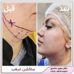 ساکشن غبغب