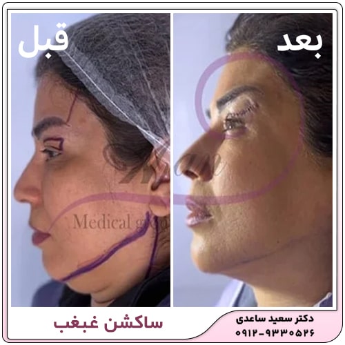 نمونه کار ساکشن غبغب