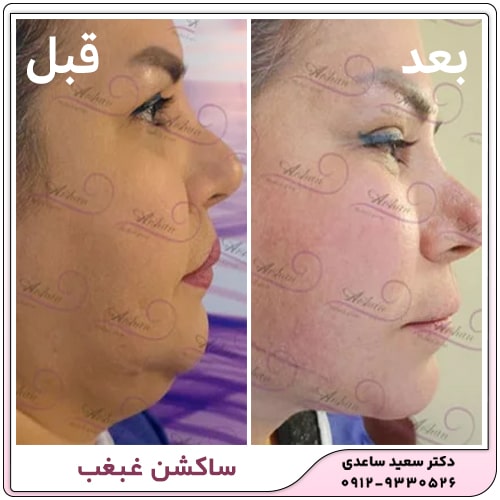 نمونه کار ساکشن غبغب