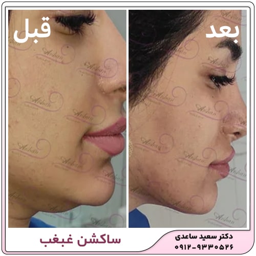نمونه کار ساکشن غبغب