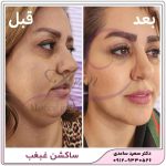ساکشن غبغب