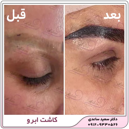 کاشت ابرو