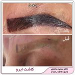 کاشت ابرو طبیعی