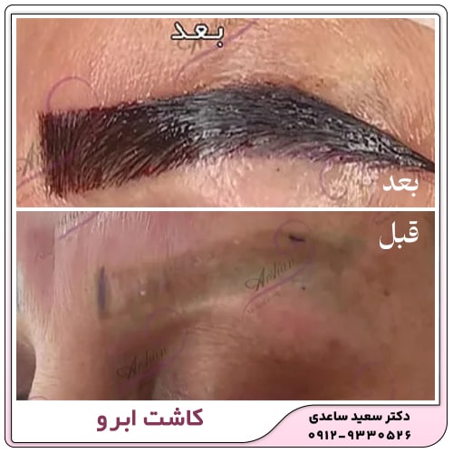 کاشت ابرو
