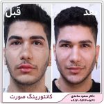 زاویه سازی فک و صورت