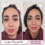 زاویه سازی فک و صورت