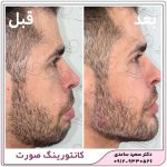 زاویه سازی فک و صورت