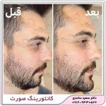 زاویه سازی فک و صورت