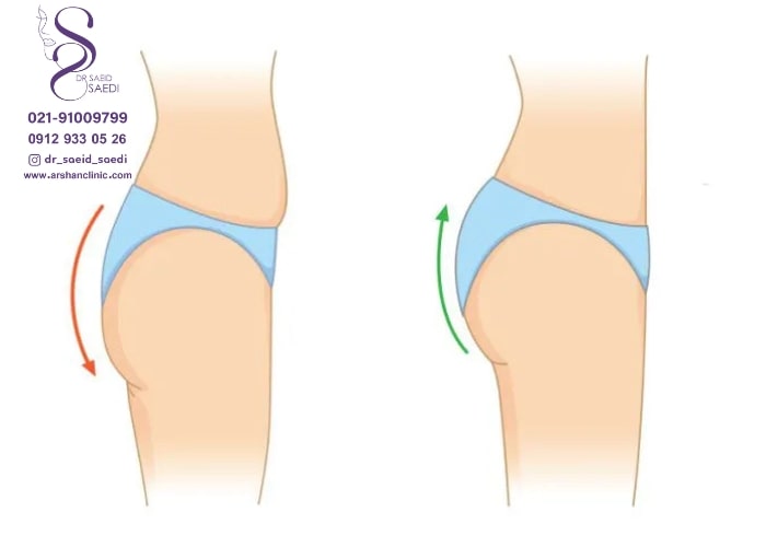 تزریق چربی به باسن