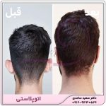 اتوپلاستی- جراحی زیبایی گوش