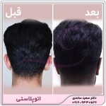 اتوپلاستی- جراحی زیبایی گوش