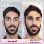 اتوپلاستی - جراحی زیبایی گوش