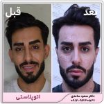 اتوپلاستی- جراحی زیبایی گوش