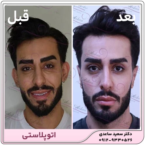 نمونه کار اتوپلاستی