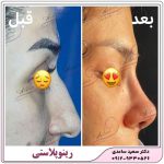 رینوپلاستی یا عمل زیبایی بینی