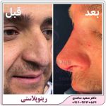 رینوپلاستی یا عمل زیبایی بینی