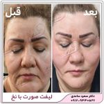 لیفت صورت با نخ