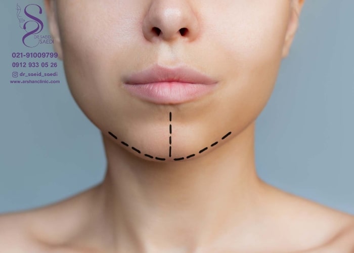 جراحی فک V لاین