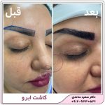 کاشت ابرو طبیعی