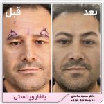 بلفاروپلاستی پلک