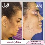 ساکشن غبغب
