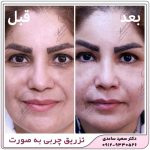 تزریق چربی به صورت