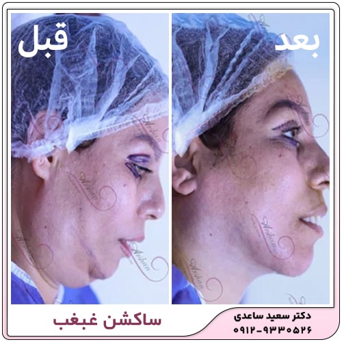 نمونه کار ساکشن غبغب