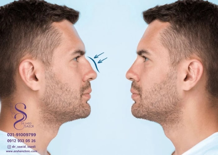 بهترین فرم برای بینی اقایان چگونه تعیین می شود؟