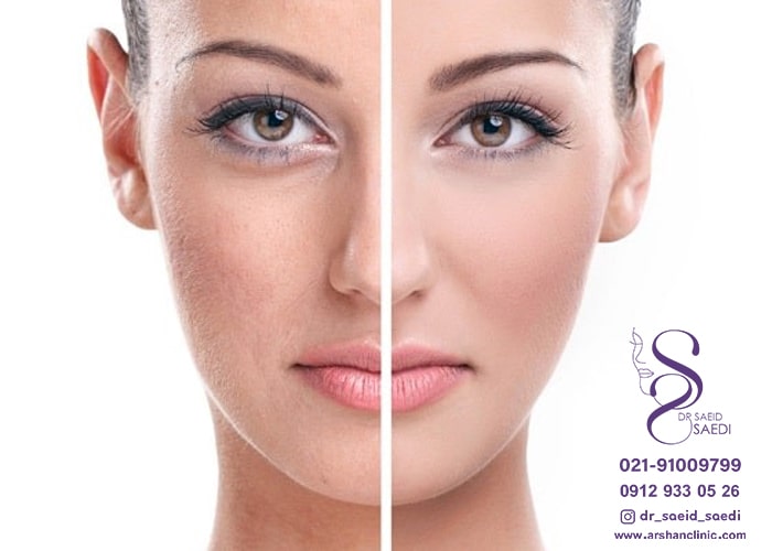 هزینه جوانسازی پوست چقدر می شود؟