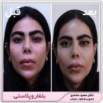 بلفاروپلاستی پلک