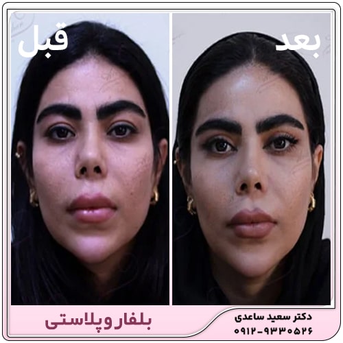 نمونه کار بلفاروپلاستی