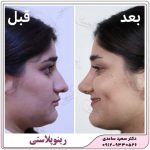 رینوپلاستی یا عمل زیبایی بینی