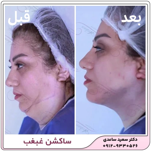 نمونه کار ساکشن غبغب