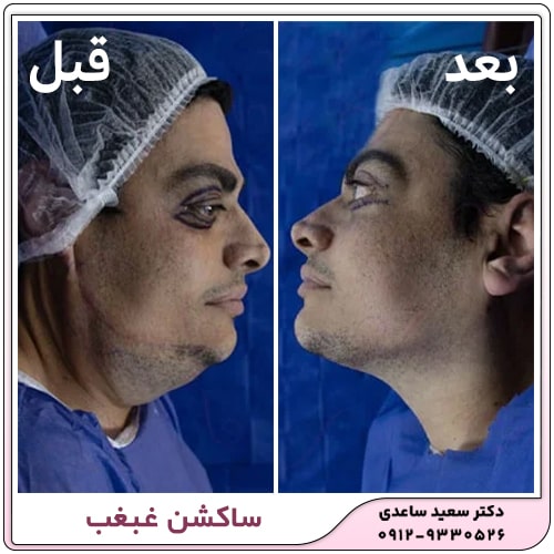 نمونه کار ساکشن غبغب