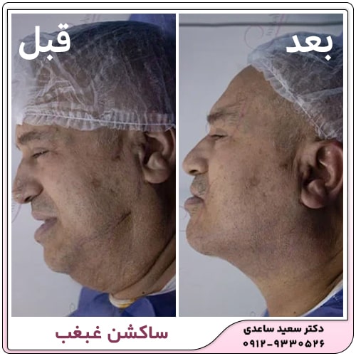 نمونه کار ساکشن غبغب