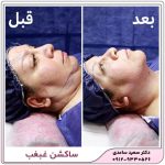 ساکشن غبغب