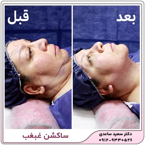 نمونه کار ساکشن غبغب