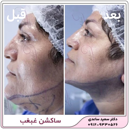 نمونه کار ساکشن غبغب
